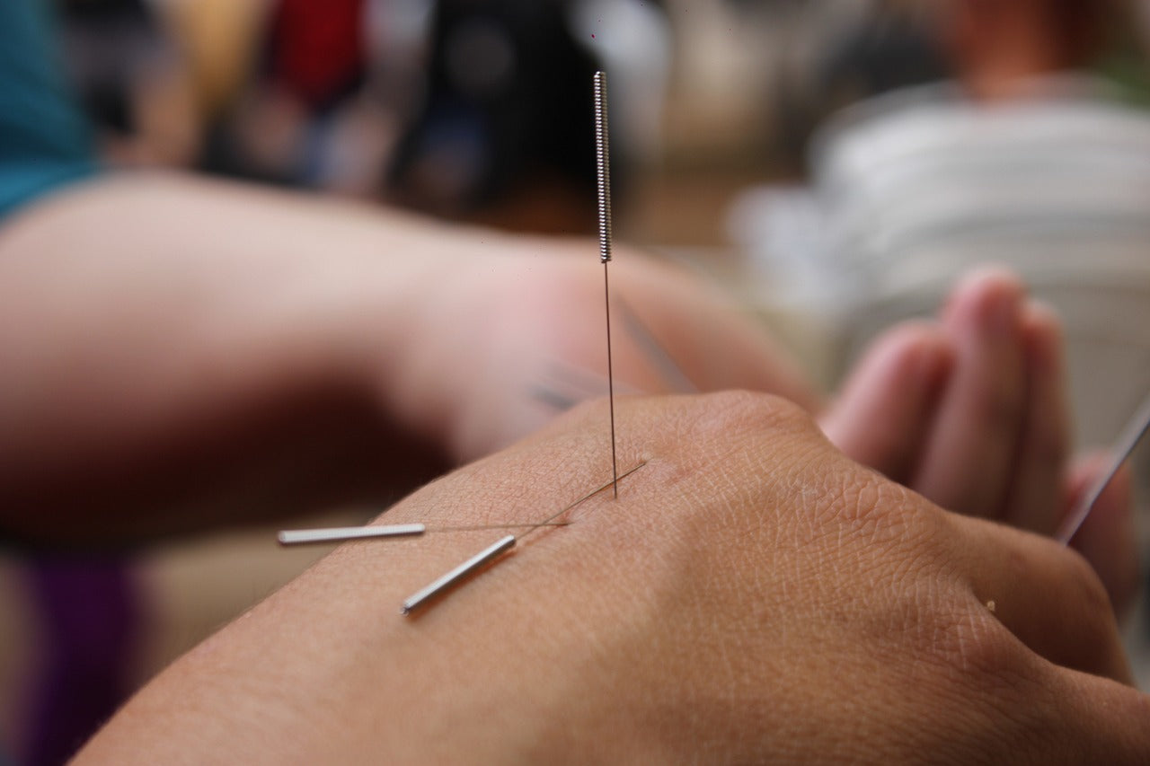 acupuncture needles in the back of a hand