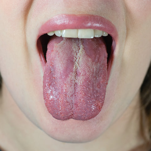 photo of tongue with candida