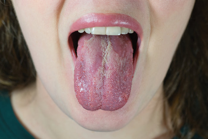 photo of tongue with candida